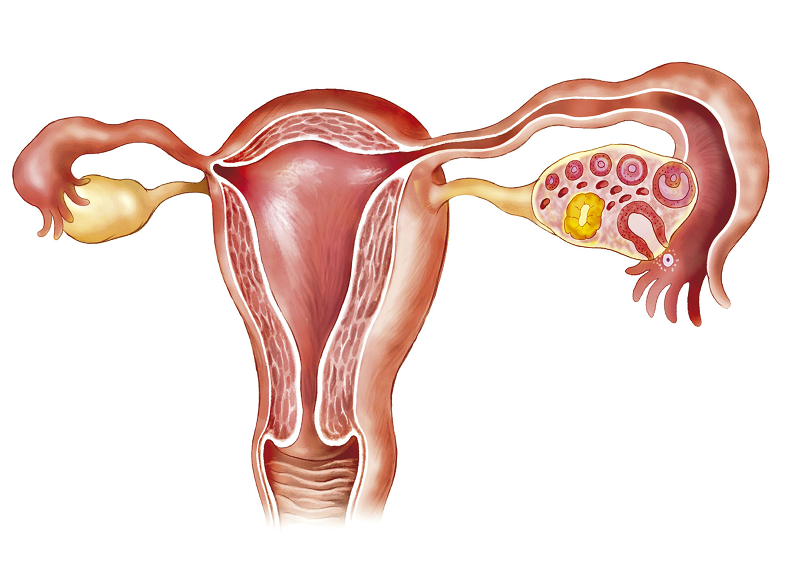 多囊卵巢综合征是什么意思？听听重庆御和堂老中医讲解