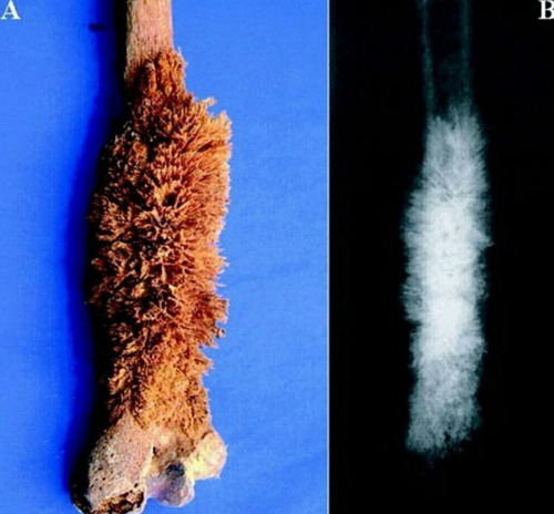 重庆市看骨癌比较好的医馆