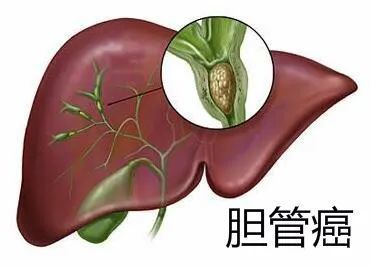 重庆市中医馆哪家治疗胆囊癌好