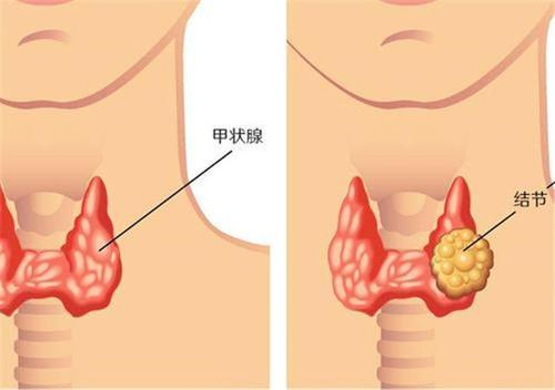 重庆治疗甲状腺结节比较好的医馆