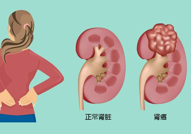重庆比较好的肾癌中医馆路线