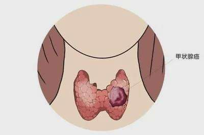 重庆治疗甲状腺结节比较好的中医医馆