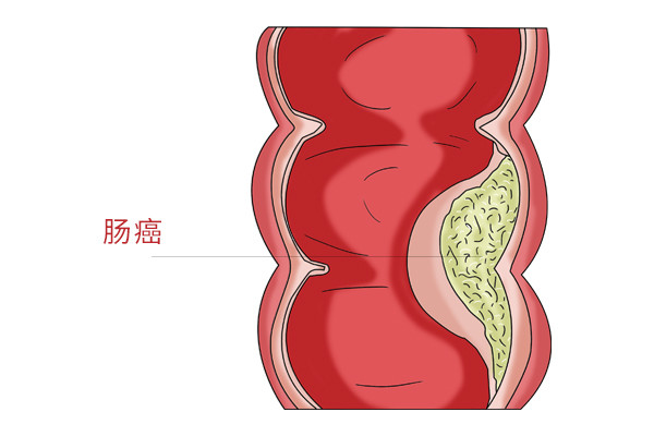 重庆治疗直肠癌比较好的中医医师