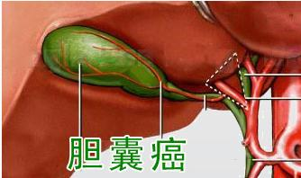 重庆中医治疗胆囊癌有效吗