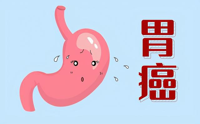 肿瘤医师石毓斌:为什么会得胃癌？实际上是幽门螺杆菌感染！