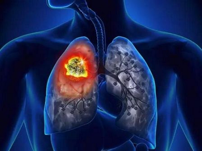 不抽烟的女性也有患肺癌风险,中医肿瘤医师石毓斌说:与这4个方面有关