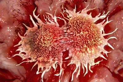 重庆肿瘤科医院|癌症到底是不是一种传染病?
