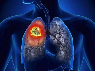 重庆肿瘤科医馆老中医聊一聊中医是如何抑制肺癌细胞的转移和复发的