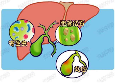 重庆肿瘤专科医院|为什么都说中医治疗胆管癌效果好?治疗胆管癌优势是什么