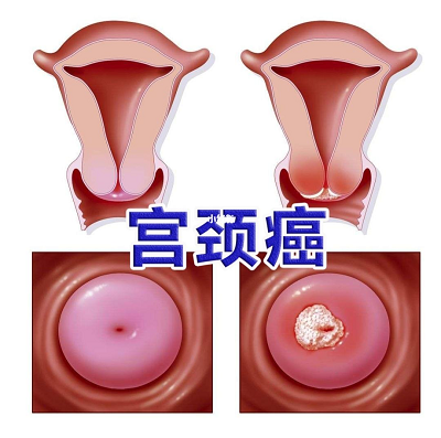 重庆御和堂肿瘤老中医罗登祥讲解这些你应该知道的宫颈癌引发原因