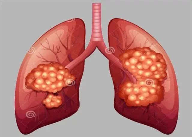 重庆中医肺癌医师:肺癌为什么被称为癌症