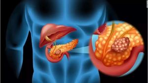 重庆中医治疗胰腺癌好的医师:胰腺癌和糖尿病在治疗前应区分清楚。