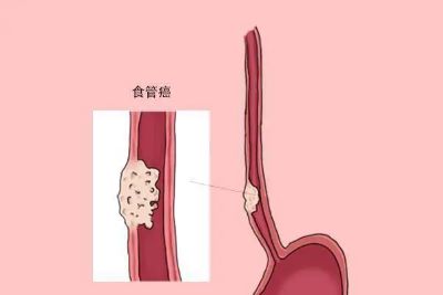 重庆中医治疗食管癌老中医:食管癌竟然有遗传的可能性