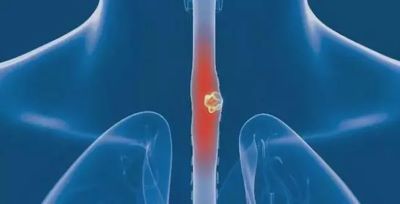 重庆中医肿瘤有老中医:原来食管癌还会引发其他的一些疾病