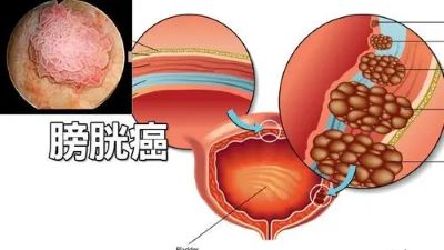 重庆御和堂肿瘤老中医:膀胱癌有哪些常见症状