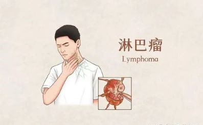 重庆治疗淋巴癌老中医:为什么淋巴癌会年轻化