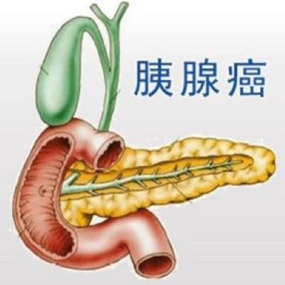 重庆中医肿瘤科医馆科普|胰腺癌需要检查哪些项目