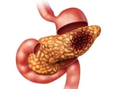 重庆中医肿瘤医院排名|诱发胰腺癌发病的病因有哪些