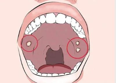 重庆治疗口腔癌老中医:口腔癌吃什么对病情有好处呢