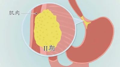 重庆中医肿瘤医师:贲门癌死前有哪些症状