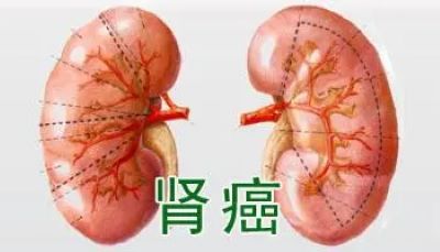 重庆老中医罗登祥:中医学治疗理念对预防肿瘤转移有着重要意义