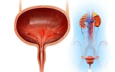 经常憋尿会引发膀胱瘤吗?听听重庆中医医师罗登祥怎么回答