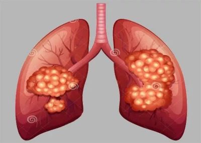 当咳嗽有以下表现时,一定要警惕肺癌