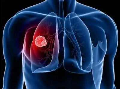 中医对肺癌与西医有以下不一样的见解