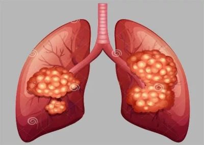 确诊肺结节可以选择中医治疗吗?听听重庆老中医罗登祥的回答 确诊肺结节可以选择中医治疗吗?听听重庆老中医罗登祥的回答