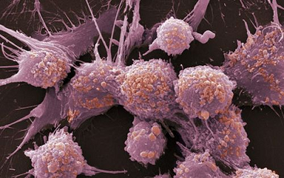 重庆御和堂科普|癌症患者化疗需要做多少次?