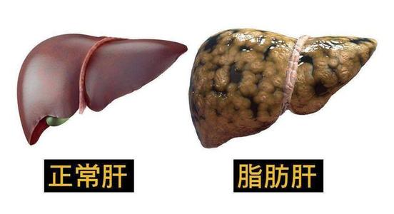 得了脂肪肝怎么办-重庆御和堂中医告诉你这几种方法治疗效果更好