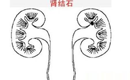 患上肾结石怎么办-重庆御和堂中医这几种治疗方法比较好