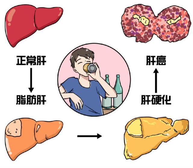 中医治疗脂肪肝有什么妙招？