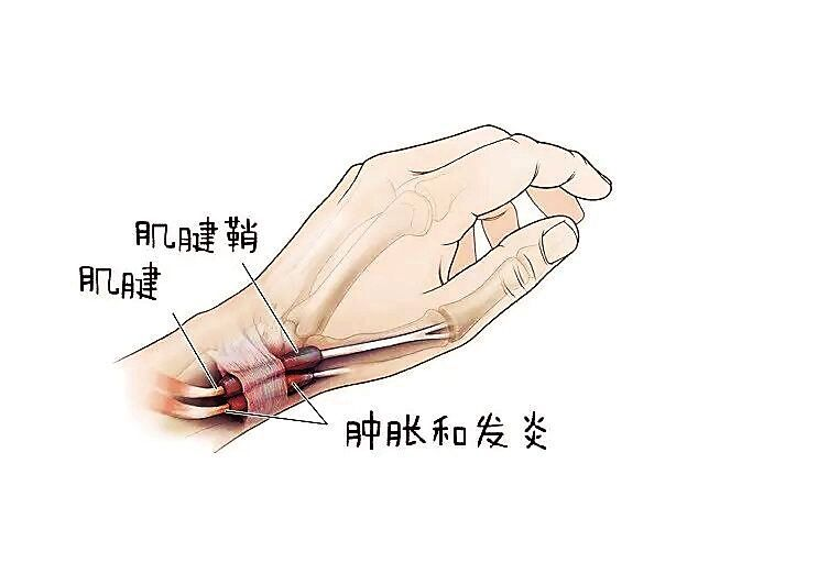 腱鞘炎