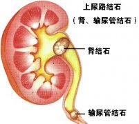 肾结石不能吃什么食物