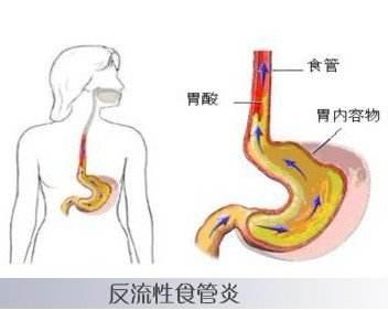 什么是食道炎_重庆中医医院