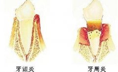 治疗牙周炎的方法_重庆中医医院