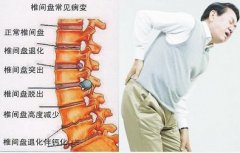 腰间盘突出的主要症状_重庆中医医院