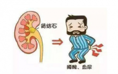 肾结石前期都有那些症状，重庆御和堂中医治疗怎么样？
