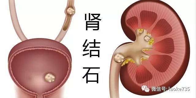 导致肾结石的因素