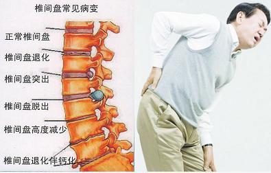 关于腰椎间盘突出的科普-症状