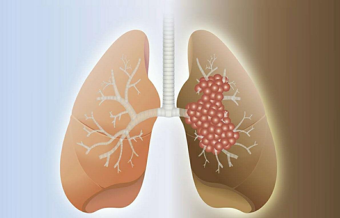 后背痛是肺癌的症状吗？肺癌的症状有哪些？