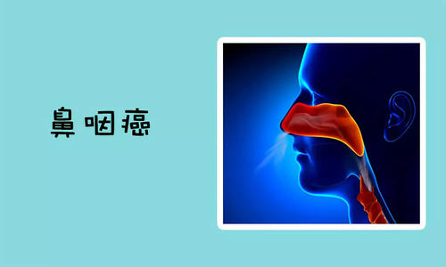鼻咽癌术后如何防止复发？你了解吗？