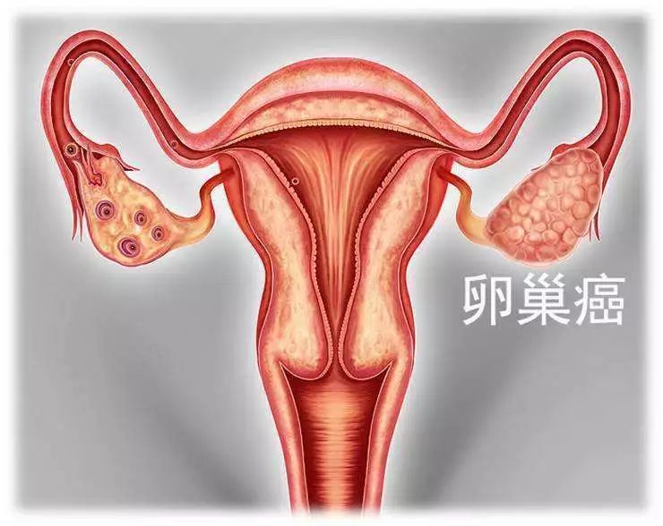 卵巢肿瘤的治疗方法有哪些？重庆市哪里的老中医好？