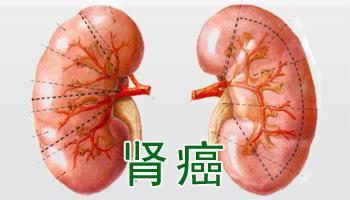 肾癌晚期死前临床症状 有哪些不得不知？